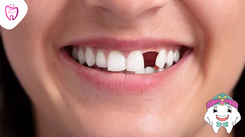 Gigi Ompong_Gigi Palsu_Crown Gigi_Bridge Gigi_Gigi Tiruan_Arini Dental Care