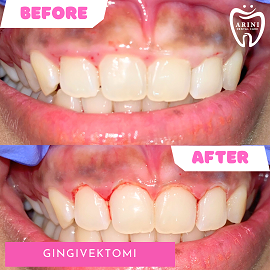 atasi gummy smile dengan gingivektomi