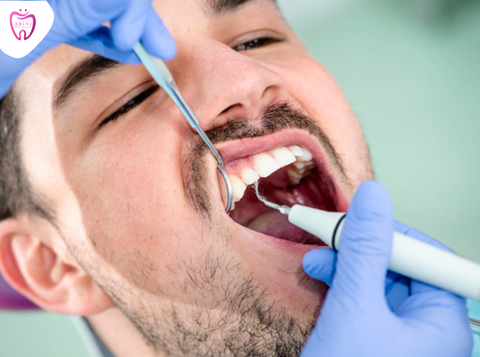 scaling karang gigi_arini dental care