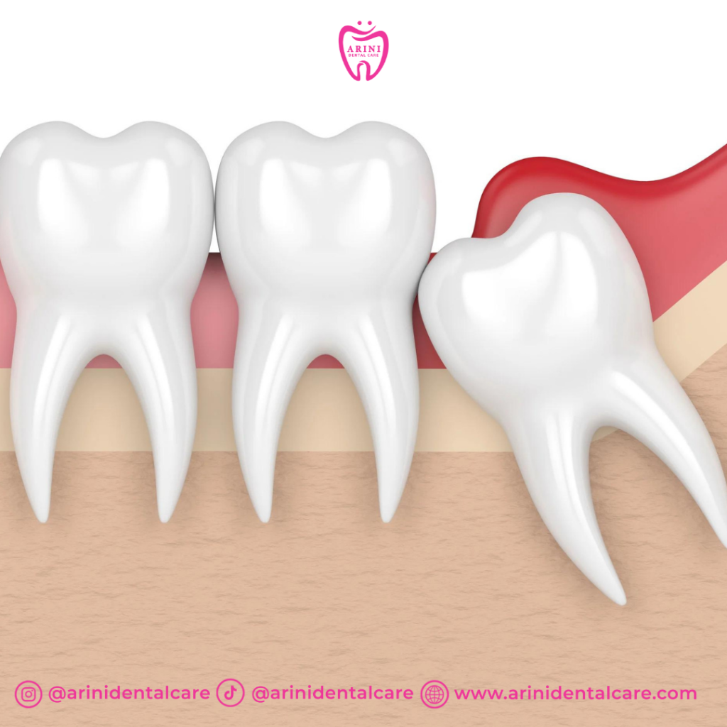 Odontectomy_Pencabutan Gigi Bungsu_Arini Dental Care