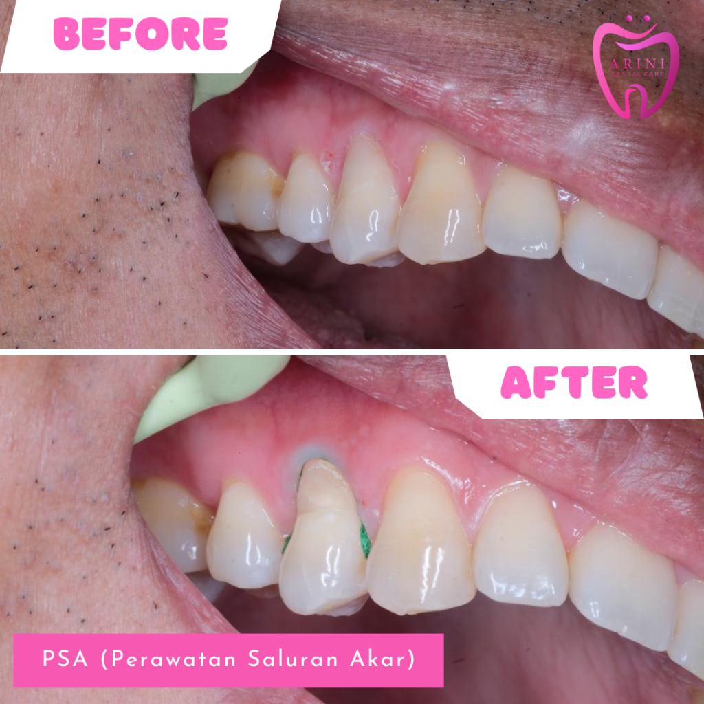 perawatan saluran akar Arini Dental Care