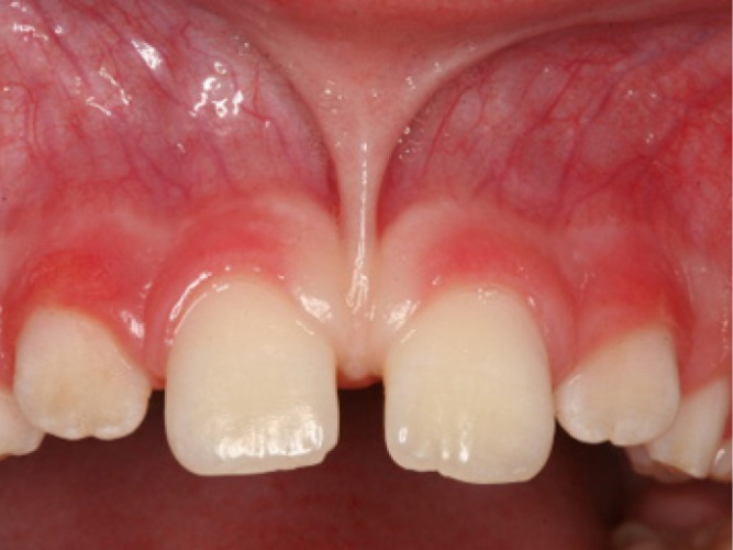 frenektomi arini dental care