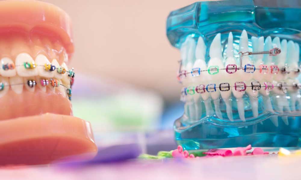 klinik arini dental care_pemasangan behel ortho