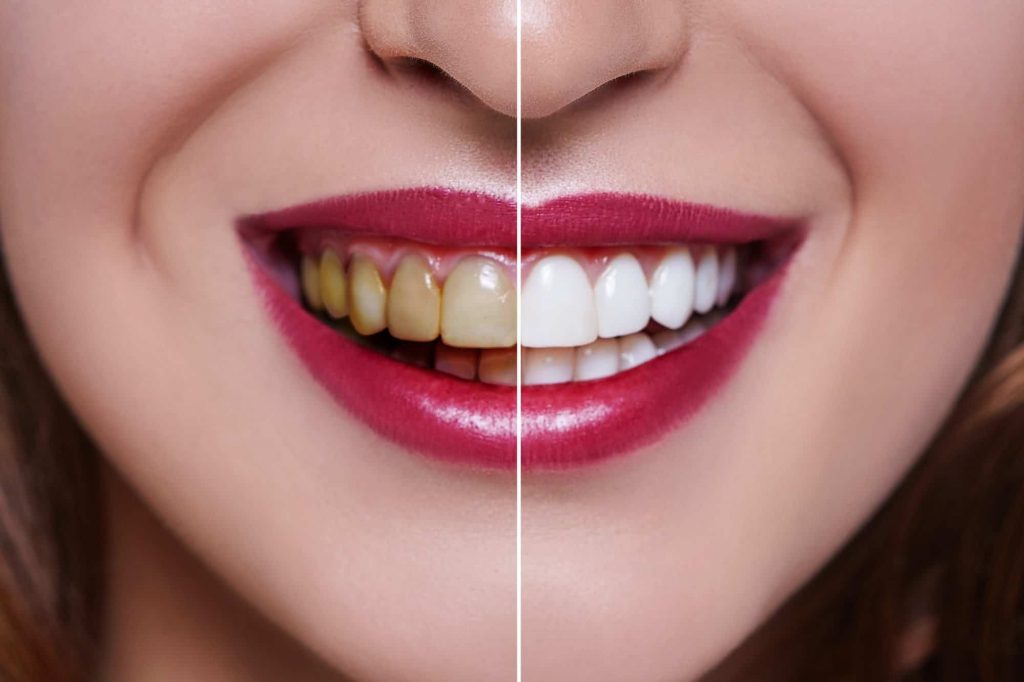 Bleaching_Gigi_Klinik_Arini_Dental_Care