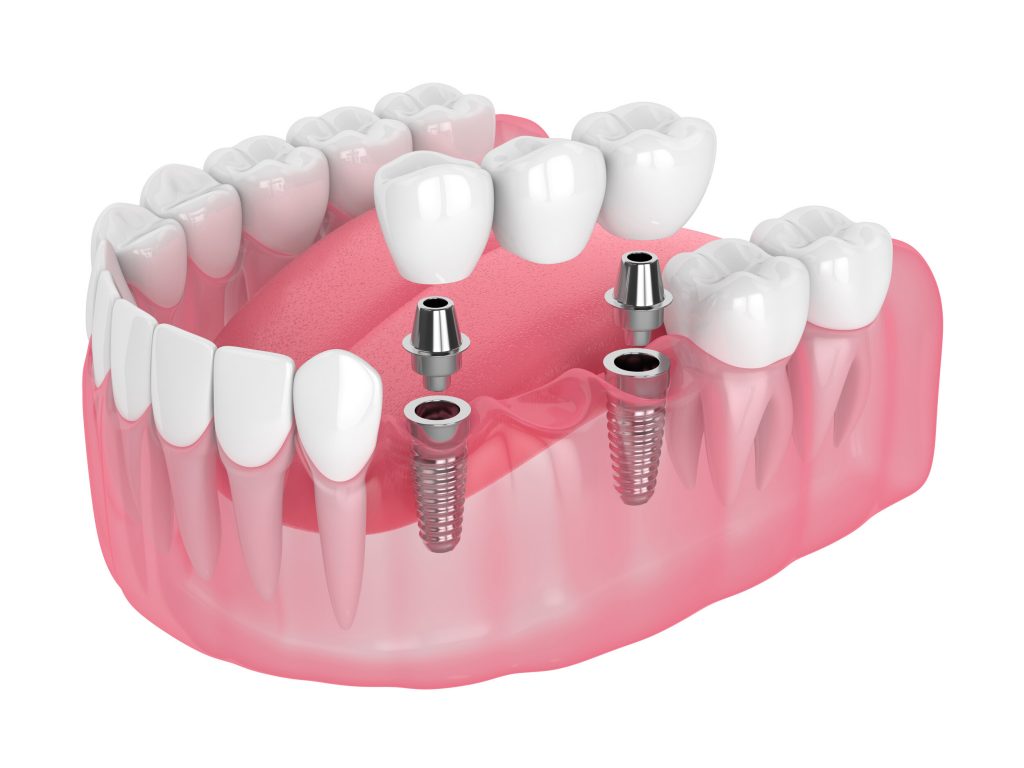 Implan Gigi Arini Dental Care