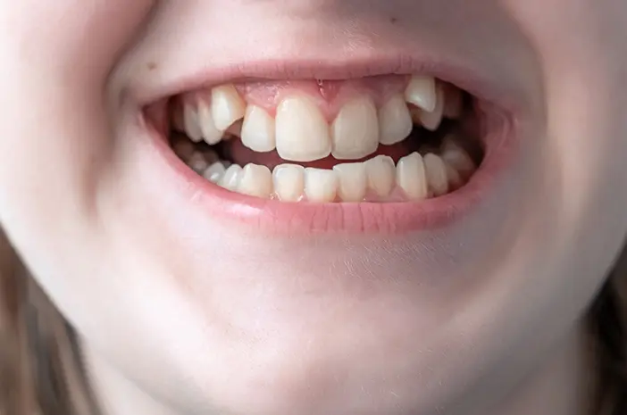 perbaiki gigi gingsul di Arini Dental Care