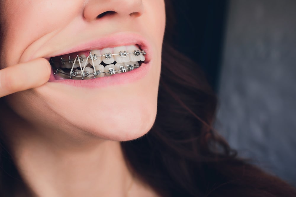 karet-elastik-behel-arini-dental-care