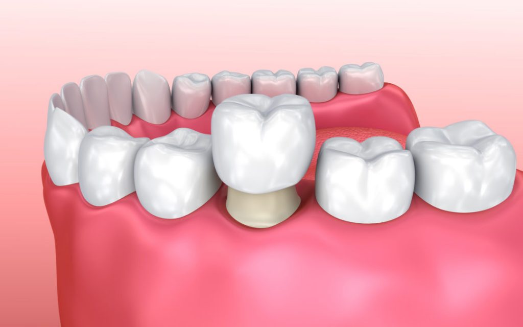 kelebihan_gigi_tiruan_zirconia