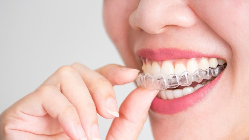 Mengatasi Masalah Gigi Berjejal dengan Invisalign