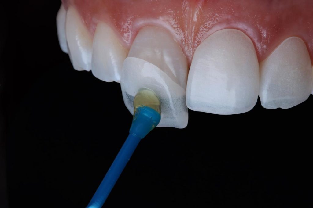Perbedaan veneer direct dan penambalan anterior