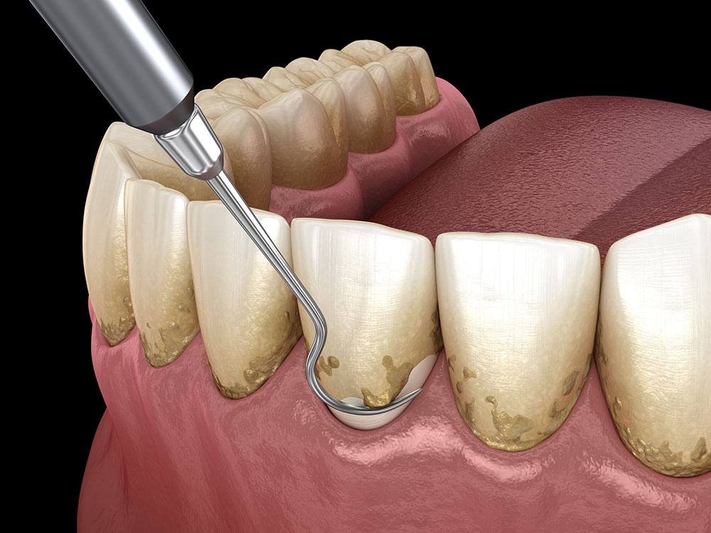 Perbedaan Dental Spa dengan Scaling Gigi