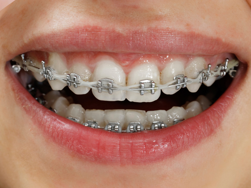 Perbedaan behel self ligating dan metal