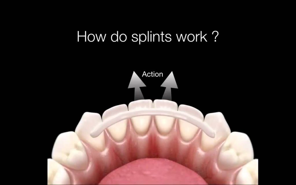 Apa itu splinting dan bagaimana cara kerjanya?