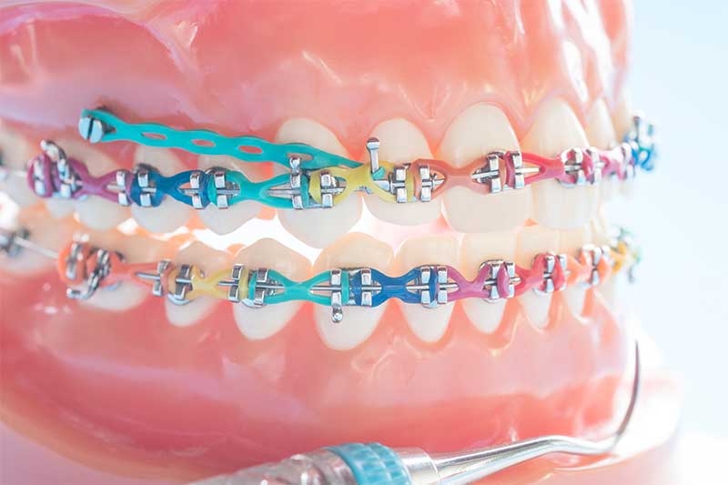 Apa itu miniscrew dan bagaimana fungsinya dalam orthodontic?