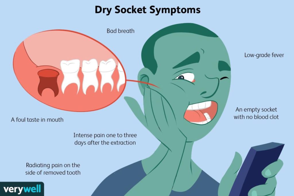 Apa itu dry socket dan apa saja penyebabnya?