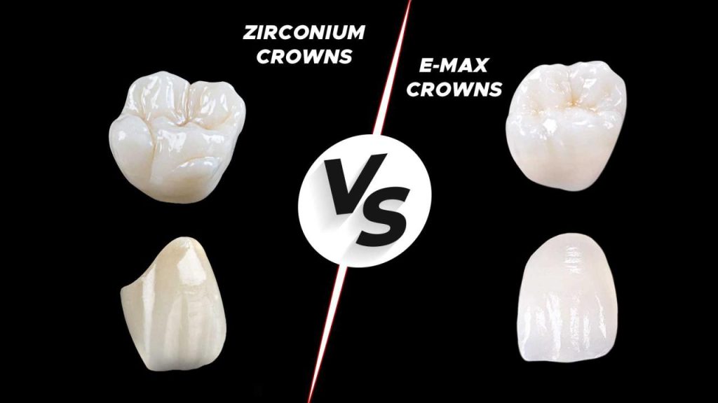 Perbadingan jenis gigi tiruan dengan bahan Maryland, Emax dan Zirkonia